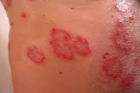 Successful Natural Herbal Cure of Psoriasis: Not Just Control But Complete Cure