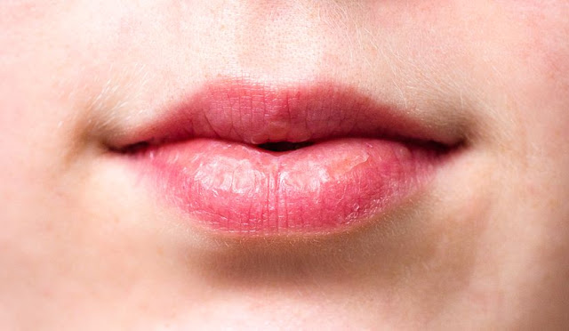 10 Cara Mengatasi Bibir Kering Dan Pecah-Pecah