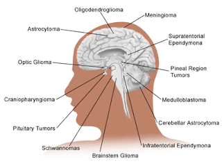 Gejala Kanker Otak