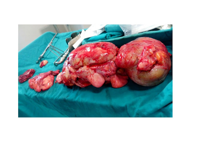 A 21-Kg Tumor Removed by Doctors at Paras Hospital, Gurgaon
