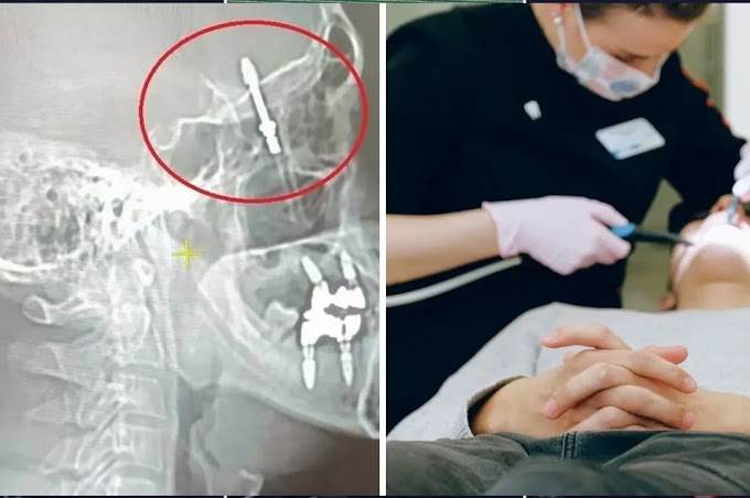 Fue al dentista, este le hizo fuerza demás y le hizo un implante en el cerebro