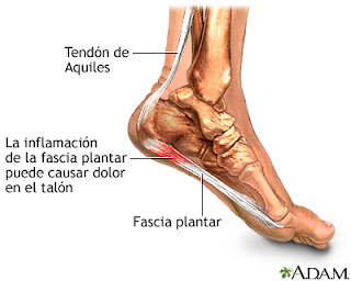 En la imagen podemos observar el tendón de Aquiles, la fascia plantar y una inflamación probocada por la fascitis plantar, causante de dolor