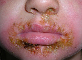 infection around the mouth and nose caused by impetigo