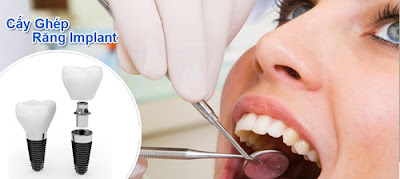  Ưu điểm của cấy ghép implant