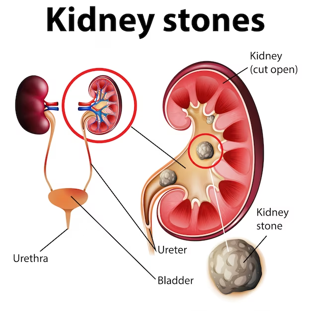 Kidney Stone Surgery in Delhi