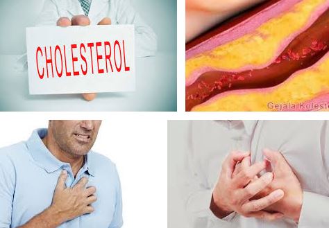 Gejala, Kolesterol, Akibat, Penyebab,dan Fungsi ,Penurun, Kolesterol Tinggi