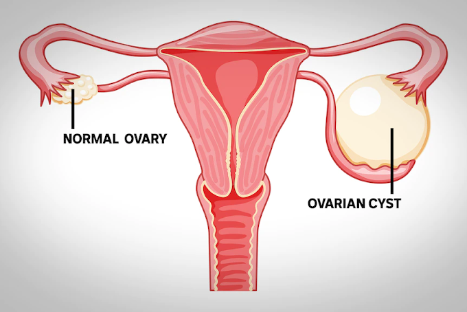 Natural Remedies for Ovarian Cyst