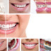 Niềng răng được áp dụng như thế nào?