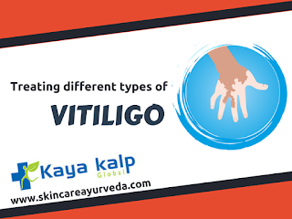 https://skincareayurveda.com/kayakalp-vitiligo-treatment-procedures/