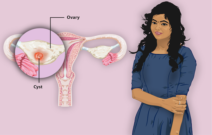 ruptured ovarian cyst symptoms