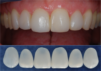 Làm răng veneer sứ – Răng sứ thẩm mỹ giúp bảo tồn răng thật