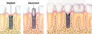 Trồng răng implant đem lại sự thoải mái