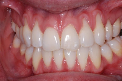 Cách phòng tránh niềng răng bị tụt lợi cần thiết cho bạn-2