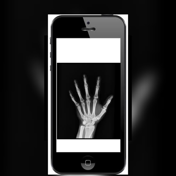 मोबाईल मध्ये एक्स रे चा फोटो काढून डॉक्टरांना दाखवा ; बारामती मधील वैद्यकीय महाविद्यालयाचा अजब कारभार