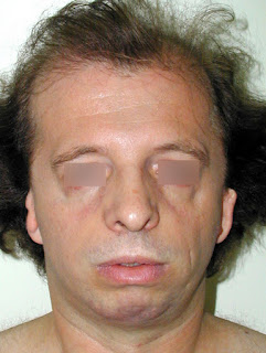 An adult with treacher collins syndrome  treacher collins syndrome images