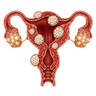 What can cause fibroid