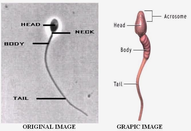  The life story of a sperm  “Jet after jet of white hot sperm shot from his enormous, rigid penis into her throbbing vagina.” But alas, sperm is never white hot, her vagina may not be throbbing, and his jets may be more like dribbles. And, glorious as the paperback literature paints it, the life of most spermatozoa seems to be among the most futile on earth. Born through a complex process in the tubes (tubules) of the testes, the spermatids or infant sperm cells spend several weeks nursed by surrounding cells and growing. Eventually they develop whip like tails and reach about a five-hundredth of an inch in length.   At this point, the sperm, fully developed but still sluggish, set out on the first and last journey of their lives. They pass into the epididymis, a small convoluted tube encased in tough protective tissue. Stretched out to its full length, the epididymis is about twenty feet long. Yet, in its casing within the scrotum, doubling back on itself continually, it measures only about an inch in length. Slowly, sluggishly, for ten to fifteen days, the sperm move through the twenty feet of tube, maturing as they go. Then they enter another tube, the vas deferens, which continues for an inch and a half before swelling to form a waiting station for the sperm, pending their journey into the outside world.   When sexual stimulation occurs, the sperm finally get excited. They begin dashing around in something of frenzy. Their behaviour may be influenced by secretions from another organ, the seminal vesicles, according to some authorities. They secrete a sugar-rich fluid into the waiting areas, and in some way the sugar may energize the sperm. As lovemaking proceeds, their departure approaches. The sperm slip into the urethra, the passage through which they will leave the male body. Surrounding the urethra on all sides at that point is a gland approximately the size and shape of a walnut: the prostate. The urethra runs through its Center. As sexual stimulation increases, the prostate grows firm. At the moment of orgasm it begins to spasm, and the sperm are instantly deluged with a milky, sticky fluid produced in the prostate and squirted out of it by the contractions. What we would now call semen, the fluid containing the sperm, is then ejected by strong muscular contractions from the penis into the dark, moist and potentially hostile environment of the vagina.   From a man's point of view, as a man and woman make love, he thrusts his penis in her vagina, and, after a few moments or a few minutes of intercourse, depending on his staying power, he feels that glorious moment of impending ejaculation, and then falls headlong into his orgasm. As he ejaculates, his penis ejects up to 500 million spermatozoa into his partner.   But as we have seen elsewhere, a large proportion of the semen evaluated into a woman's vagina is expelled again quite soon after intercourse as flow back. How, then, does a woman get pregnant?   There isn't an open channel between the vagina and the uterus. The neck of the cervix, which is effectively the entrance to the uterus, is not empty. It is filled with mucus, which serves both to prevent bacteria entering her uterus and to give her some control over how many - and, if she has mated with more than one man, whose - sperm can enter her and potentially fertilize her egg. This mucus contains both fibres and extremely narrow channels, the latter no wider than the head of a sperm.   The mucus flows from the cervix into the vagina, taking with it any invading bacteria, but still allowing sperm to swim upwards, against the flow, towards the uterus. At all times a woman has to balance the advantages of letting sperm though and keeping disease organisms out. For example, during pregnancy, when a woman has no use for sperm, her cervical filter becomes impenetrable to sperm and she ejects all the sperm she collects during intercourse in the flow back of semen and mucus which she emits from her vagina about thirty minutes after sex.  But the surprising thing is that a woman uses her cervical mucus to regulate sperms' access to her uterus all the time, at every point in her reproductive life, and the way she does it depends on whatever reproductive strategy will suit her best at the time. One of the reasons that a woman's secretions change during her menstrual cycle is that at some points in her cycle she needs to flush out dead cells and blockages which might hinder the access of sperm to her uterus. This thinner, faster flowing mucus forms the clear, sticky mucus which appears on her vaginal lips and underwear.   A woman's ability to block or clear the channels in her mucus, by changing its consistency or flow rate, or by blocking it with menstrual debris, white blood cells or even invading sperm, is the primary weapon she has in fending off unwanted sperm and encouraging the sperm from men she has decided would be suitable fathers for her children. According to Baker, for example, if she is motivated to have a child by a man who is not her long-term partner, she will unconsciously manipulate the time of intercourse and the composition of her cervical mucus so that she maximizes the chance of being fertilized by the "right" man.  Her long-term partner may be good for child rearing, but he may not, for example, be an alpha male! It's very necessary to emphasize that none of this is conscious behaviour (though I suppose it can be, sometimes). We are not so far from our animal ancestry, and in many ways we still follow the dictates of our instincts.   As you may have guessed, evolution has not left men behind in the battle to fertilize a woman's eggs. But a man's sperm have two potential obstacles to overcome: the first, a woman's reluctance to be fertilized by him; the second, the competition of any sperm left inside her by another male. We'll see how men overcome this in a moment.   In the moments after intercourse, the cervix dips down into the seminal pool left by the man's ejaculation, gapes open, and a complex interaction between the sperm and the seminal pool develops during which sperm leave the pool and enter the cervical mucus. How many of the sperm make it depends on the woman's receptiveness: as described above, she can control this and often does so - during pregnancy, for example, no sperm can enter the cervical mucus and they are all ejected in the flow back. But the other factor which controls how many make it is whether the woman has an orgasm or not: the passage of sperm into her cervical mucus is greatly enhanced if she orgasms, for the contractions of her muscles repeatedly dips her cervix into her mate's semen and also opens up the channels in her cervical mucus to allow many more sperm to pass upwards out of her vagina.  So, every healthy sperm struggles for survival against overwhelming odds when it arrives in the vagina. Almost none will reach the breeding ground and fulfil themselves by reproducing. But what happens to the ones which are allowed into the cervix? Therein lies another, most incredible story.  Each time a man ejaculates, he ejaculates no more sperm into his partner than are needed to top up (to the ideal number for fertilization to have most chance of occurring) those already there from the last time they had intercourse. The reason for this is easier to understand if you follow the activities of the sperm after they are introduced into the vagina. A small number of sperm swim straight through the cervix and into the uterus, then on into the oviducts, where they temporarily rest. Eventually they may meet the egg on its way down the oviduct to the uterus. Other sperm come to rest in the walls of the cervix. After  few days they continue their journey upwards. The consequence of this is that for four or five days after intercourse, there is a steady stream of sperm reaching the oviducts. The remainder of the sperm which manage to get into the cervical mucus simply stay there until they are eventually killed by the woman's white blood cells or swept out in her mucus flow.   A man's reproductive strategy is based several things. First, on ejaculating as many sperm as are needed to keep the "reservoirs" in the walls of his partner's cervix topped up, so that in effect his partner has fresh sperm in her oviducts all the time. If more than a week has passed since the last session of intercourse, he will ejaculate a full load of sperm - up to 500 million. If it's been only three days since the last session of intercourse, he ejaculates only 200 million. Remarkably, the number of sperm he ejaculates also seems to vary depending on how much time the couple have spent together since their last intercourse - the less time they spend together, the more chance the woman has to be unfaithful, and the more sperm he ejaculates.  So the number of sperm he ejaculates is an unconscious process determined by these two factors. But how does his body do this? Simple - how many sperm he ejaculates depends on how much sperm his body moves from his epididymis into his urethra in the moments before he ejaculates. (You feel your sperm moving out of the epididymis as a subtle swelling sensation, or a feeling of fullness, at the base of your penis in the seconds or minutes before you reach the point of no return, the point where you know you are going to ejaculate. If you watch out for it, you'll feel it.)   Second, sperm are not all created equal. As we saw above, some sperm stay in the cervical mucus - their function is to block the channels through the mucus so that other men's sperm cannot physically penetrate it. These blockers are large sperm designed for the job. But there are other types of sperm, too: egg getters and killers. We'll come back to this in a minutes  Third, a man can physically guard his partner from other men by spending time with her. As we saw above, his body adjusts how much he ejaculates according to how much time they have spent apart, and therefore how possible it is that another man may have inseminated her.   But let us now suppose that a woman has - at some level, conscious or not - chosen a lover because he represents a better bet for fathering her child than her partner. She is going to be unfaithful to her partner, and the first battle in the forthcoming sperm war is that when she commits her act of "adultery", her lover will inject many more sperm into the woman than her partner already has in her - assuming, of course that the lover is inseminating her much less often than the partner. So he begins the war to fertilize her egg with a bigger sperm army. And because she has been aroused and wet all day, excited in anticipation of her infidelity, much of her partner's blocking sperm located in her now freely flowing cervical mucus have been swept away - another disadvantage faced by her partner's sperm in their battle to fertilize her egg.   There's another type of warrior sperm, a killer, which seeks out any sperm that don't match it, and kills them with enzymes located on its head. The woman's partner has some of his killer sperm in her uterus from his last ejaculation, but so of course does her lover - and he has many more, since he has ejaculated a huge army of all kinds of sperm into her very recently. These sperm will seek out and destroy her partner's sperm, just as her partner's sperm are doing to her lover's - but the greater numbers injected by her lover will win this battle, leaving the lover's egg-getters much more likely to fertilize her egg. In such a way can a man be "tricked" into raising a child who is not his own. That would be a reproductive success story for the biological father, and the mother, but potentially a disaster for the supposed father, especially if he does not have anymore children of his own.     ==--==