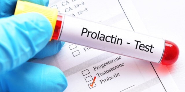 Prolaktin Hormonu Nedir? Prolaktin Yüksekliği Neden Olur? Hiperprolaktinemi Belirtileri