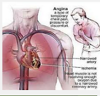 Abatement of Heart Attack in Men