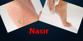 nasır nedir