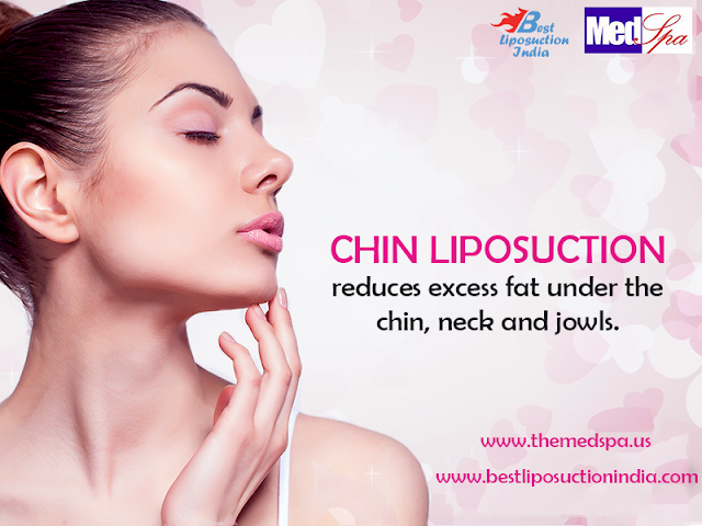 Chin Liposuction in Delhi