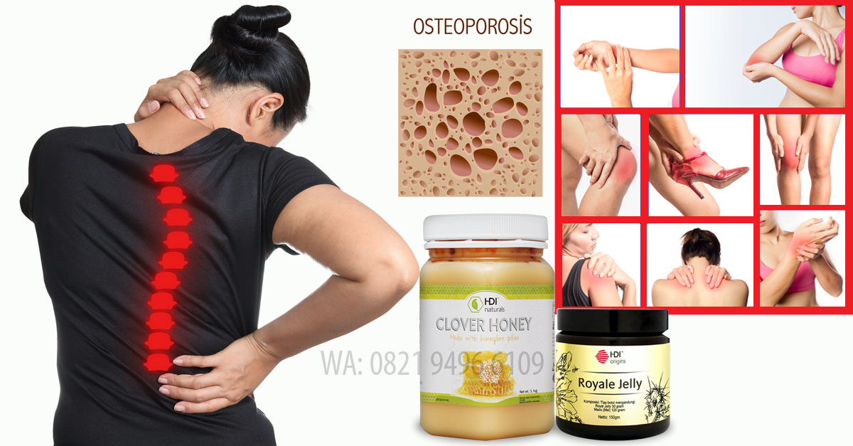 Osteoporosis mengintai