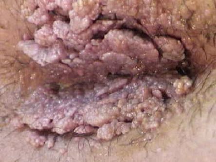 Gambar Human Papilloma Virus Atau Hpv