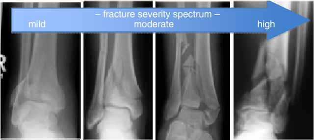 Tibial Plafond Fracture Treatment | Tibial Plafond Surgery