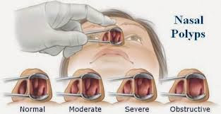 penyakit polip hidung