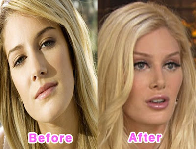 Celebrity Plastic Surgery on 16 Worst Celebrity Plastic Surgery Disasters   Hahalike Com