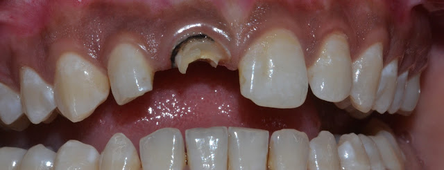 Before Treatment of Front Fractured Tooth