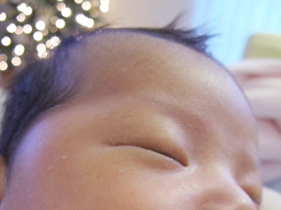 [最新] 赤ちゃん 頭皮 湿疹 画像 218847