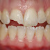 Quy trình bọc răng sứ có lâu không?