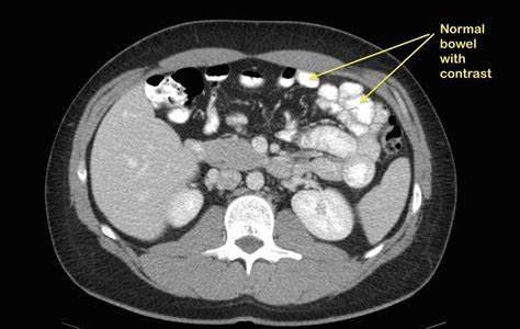 Teknik Pemeriksaan CT-SCAN Colon