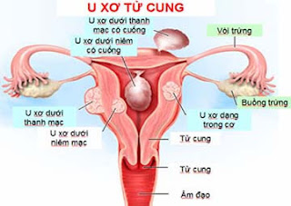 Hình ảnh bệnh phụ khoa - u xơ tử cung