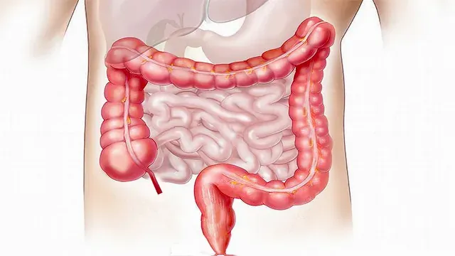 Prévenir le cancer colorectal, cancer du colon, cancer du colon symptomes, test de dépistage du cancer colorectal