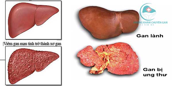 Những biểu hiện của xơ gan và cách chữa xơ gan hiệu quả nhất