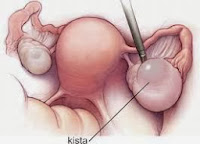 Cara Cepat Mengobati Kista