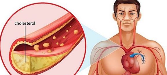 Cholesterol: Symptoms, Causes & Treatment