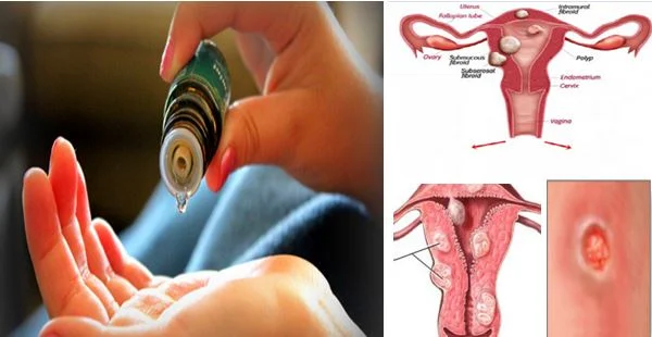 How to avoid ovarian cyst?