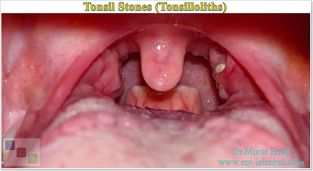 Bad Breath,Tonsil stone,Tonsilloliths,Magma,