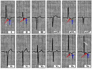 مرض نقص التروية القلبية الذبحة الصدرية Heart Disease Angina Pectoris