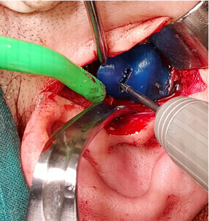 Feasibilty of Preplanned Computer Guided Gap-arthroplasty of Tempromandibular Joint Ankylosis, The Journal of Oral and Maxillofacial Surgery, Department of Oral and Maxillofacial Surgery, Cairo University, Egypt, Dr. Khashaba M.M, Dr. Ahmed M.S, 