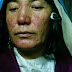 روزاسیا ( سرخی و سوزش روی)‌rosacea