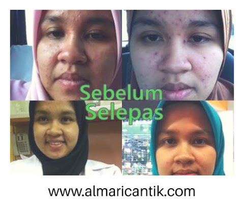 petua hilangkan parut chicken pox