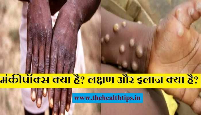 Monkeypox Virus क्या है? कैसे फैलता है, लक्षण और इलाज क्या है, पूरी जानकारी हिंदी में - The Health Tips in Hindi