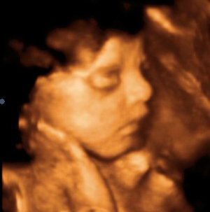 3d Ultrasound Pregnancy3