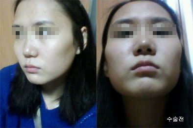 짱이뻐! - Transformed Into V-Line Face Thanks To Korea Face Contouring