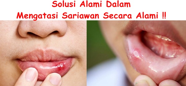 Obat Tradisional Tuntaskan Sariawan