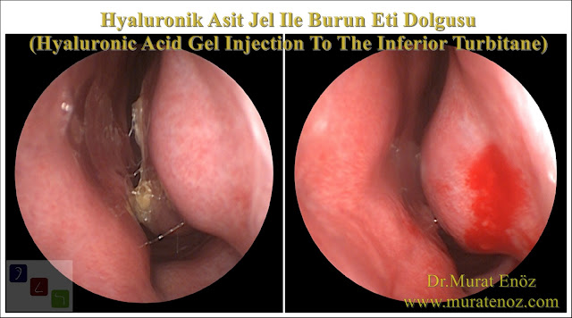 Boş burun sendromu tedavisinde Hyaluronik Asit dolgusu - Burun eti dolgusu - Treatment of Empty nose syndrome with hyaluronic acid filler - Boş burun - Geniş burun boşluğu sendromu - Burun eti büyütülmesi - Empty Nose Syndrome (ENS) - Hyaluronic acid gel in the treatment of empty nose syndrome - Empty Nose Syndrome - Treatment of Empty Nose Syndrome - Treatment of Empty Nose Syndrome in Istanbul